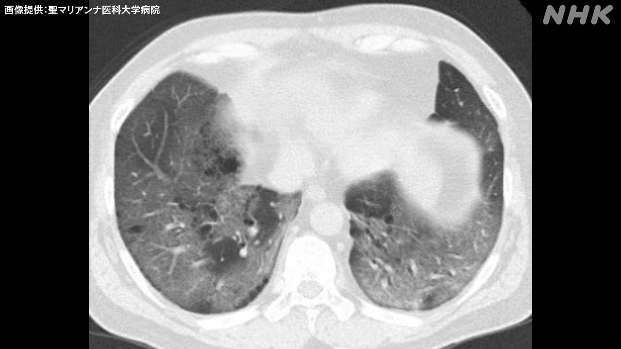 患者のCT画像　肺にすりガラス状の陰影が出現